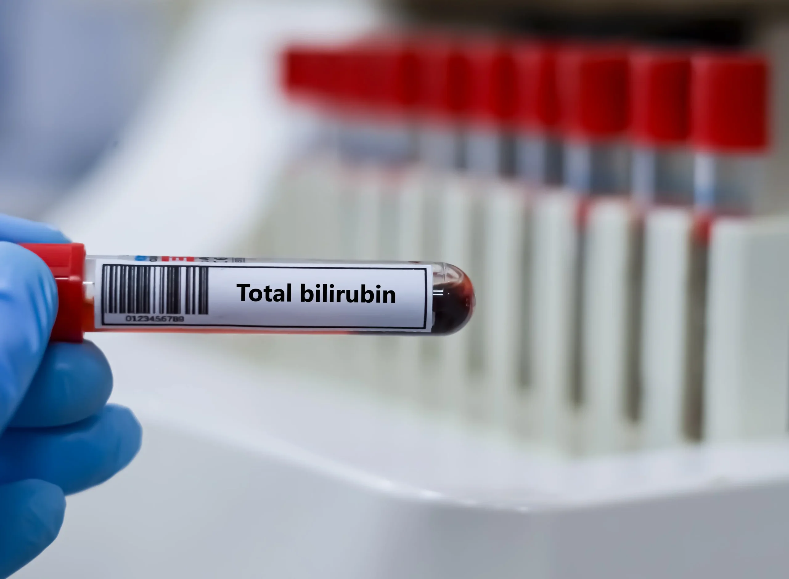 bilirubin