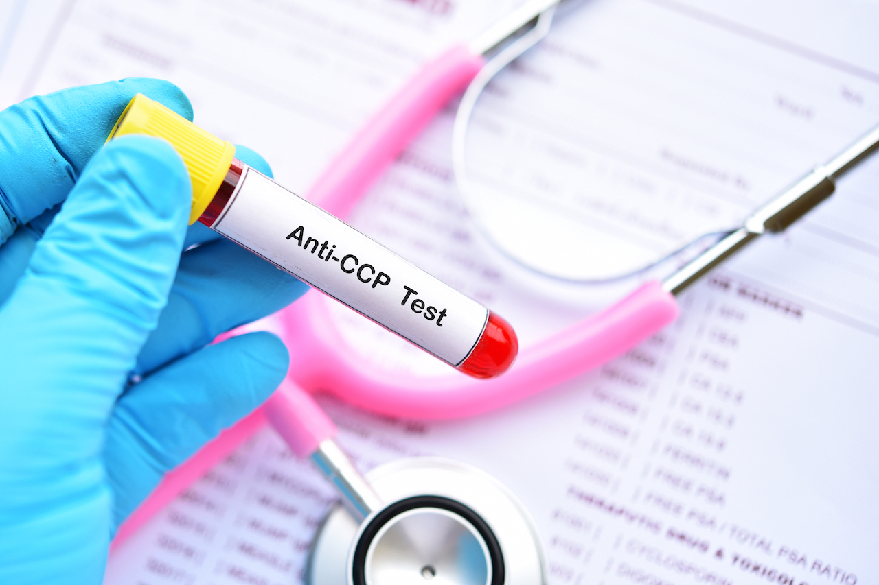 blood sample tube for anti ccp test, diagnosis for rheumatoid arthritis disease