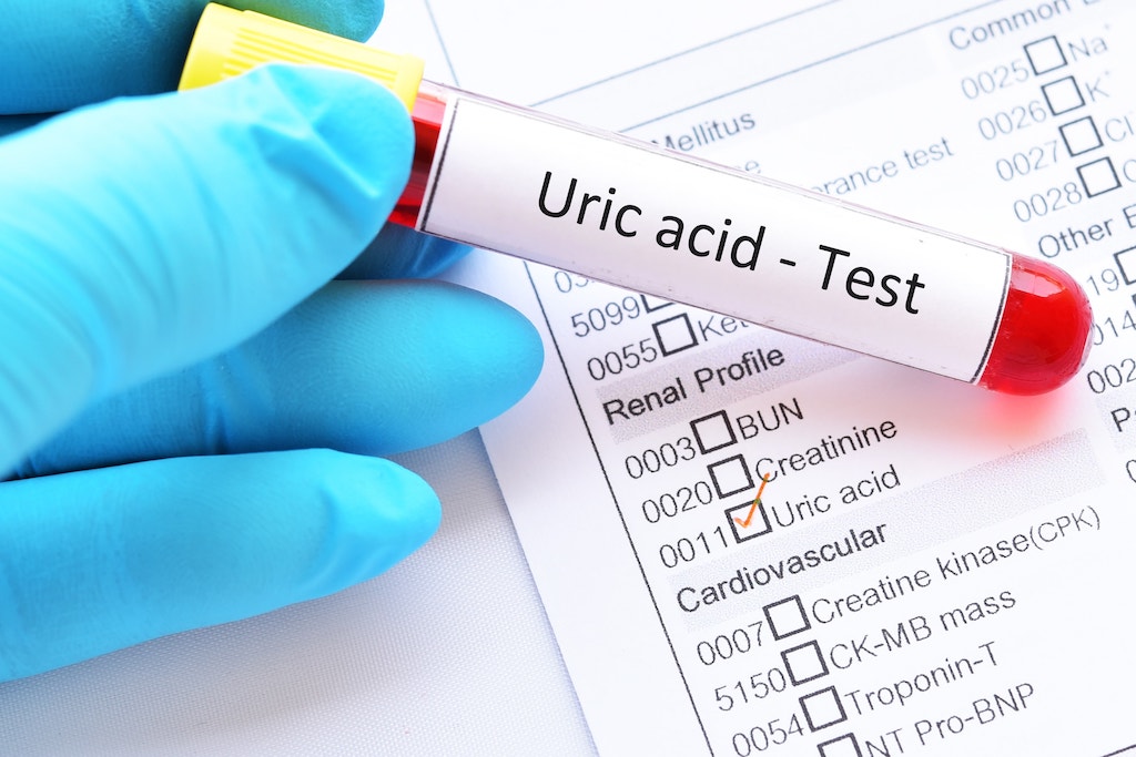 uric acid adobestock 210541980 min