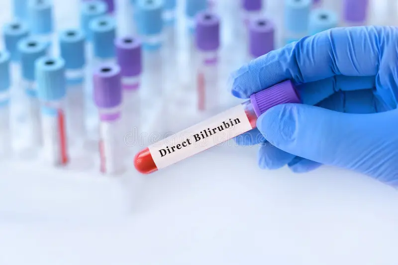 doctor holding blood sample tube direct bilirubin test laboratory diagnostics liver function bile metabolism jaundice 434339499