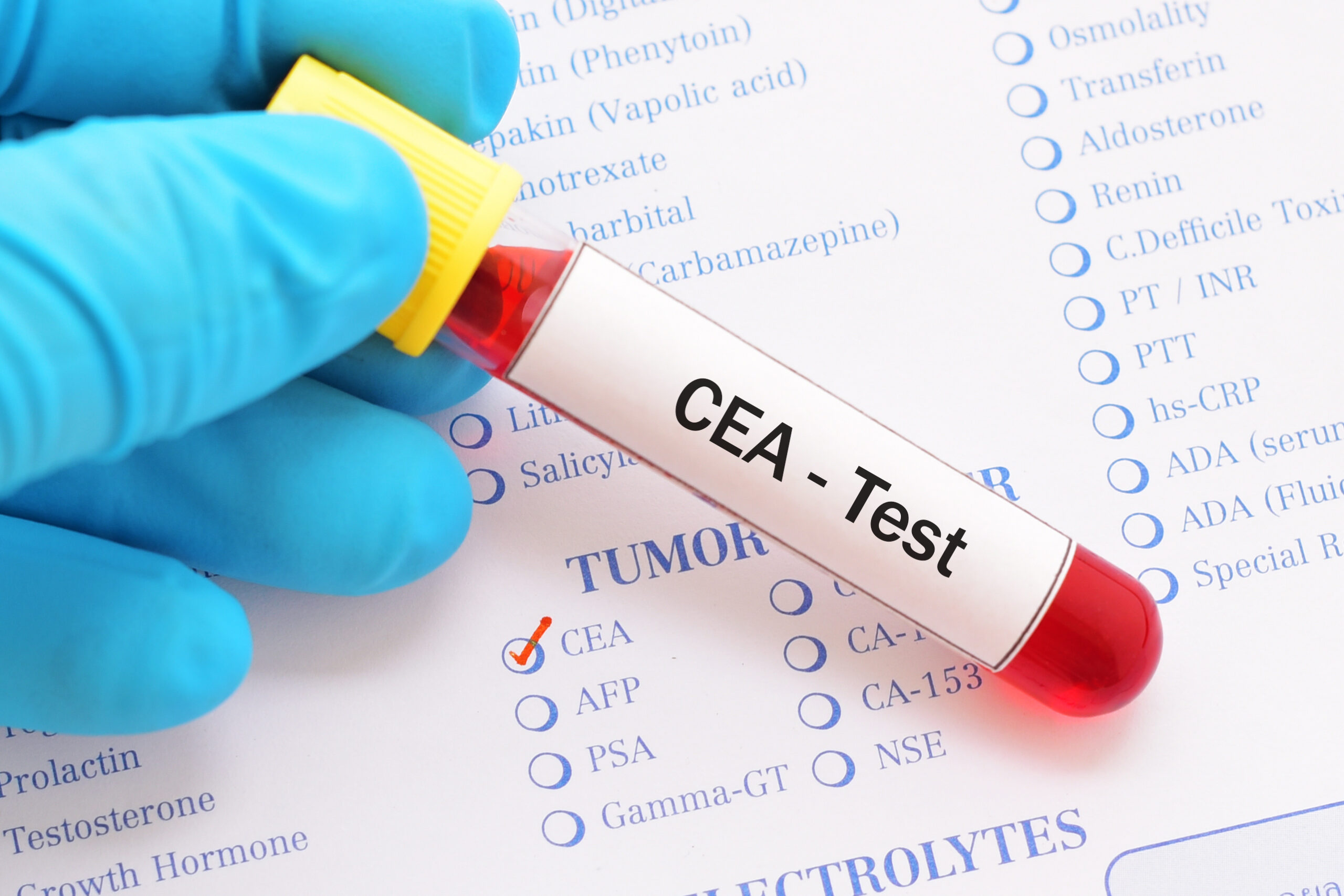 blood,sample,with,requisition,form,for,cea,test,,tumor,marker